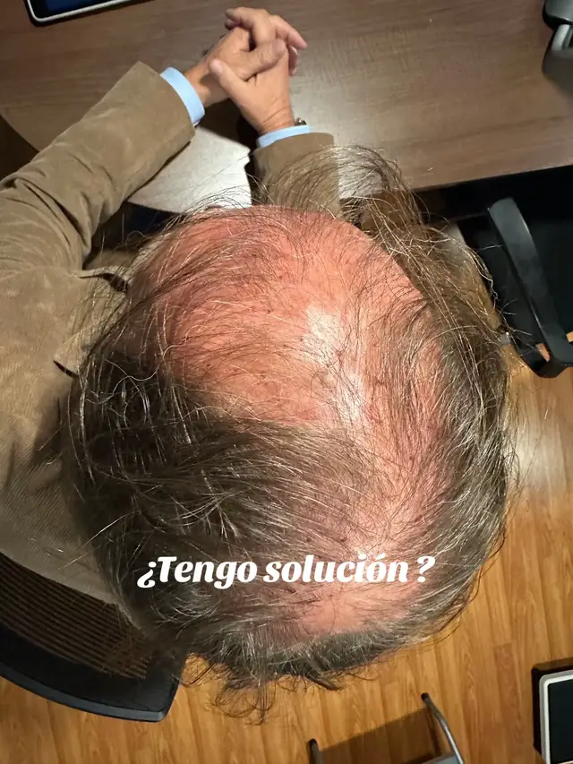 La alopecia androgénica, también conocida como alopecia androgénica o calvicie androgénica, es una condición médica que causa la pérdida de cabello en hombres y mujeres debido a la sensibilidad a los andrógenos, como la dihidrotestosterona (DHT). La alopecia androgénica es la forma más común de pérdida de cabello y afecta a aproximadamente el 50% de los hombres y el 20% de las mujeres en algún momento de sus vidas. _Causas de la alopecia androgénica:_ 1. *Genética*: La alopecia androgénica tiende a ser hereditaria, lo que significa que si tus padres o abuelos tienen la condición, es más probable que la desarrolles. 2. *Hormonas*: Los andrógenos, como la testosterona y la DHT, juegan un papel importante en la alopecia androgénica. La DHT es una forma potente de testosterona que se produce en el cuerpo y se une a los receptores de andrógenos en el cuero cabelludo, lo que lleva a la miniaturización de los folículos pilosos y la pérdida de cabello. 3. *Edad*: La alopecia androgénica puede comenzar en cualquier momento después de la pubertad, pero tiende a empeorar con la edad. _Síntomas de la alopecia androgénica:_ 1. *Pérdida de cabello*: La pérdida de cabello es el síntoma más común de la alopecia androgénica. El cabello puede comenzar a caerse en la coronilla, la frente o la parte superior de la cabeza. 2. *Miniaturización de los folículos pilosos*: Los folículos pilosos se vuelven más pequeños y producen cabello más delgado y corto. 3. *Cabello fino y débil*: El cabello puede volverse fino y débil, y puede ser más propenso a la rotura. _Tratamientos para la alopecia androgénica:_ 1. *Minoxidil*: Un medicamento tópico que se aplica al cuero cabelludo para estimular el crecimiento del cabello. 2. *Finasterida*: Un medicamento oral que se utiliza para tratar la alopecia androgénica en hombres. Funciona reduciendo la producción de DHT. 3. *Terapia de reemplazo hormonal*: En algunas mujeres, la alopecia androgénica puede ser causada por un desequilibrio hormonal. La terapia de reemplazo hormonal puede ayudar a restaurar el equilibrio hormonal y promover el crecimiento del cabello. 4. *Trasplante de cabello*: Un procedimiento quirúrgico que implica trasplantar folículos pilosos saludables de la parte posterior y lateral de la cabeza a las áreas calvas. Es importante consultar con un dermatólogo o un especialista en cabello para determinar la causa subyacente de la alopecia androgénica y desarrollar un plan de tratamiento personalizado. #alopeciaandrogenetica #implantecapilar #recuperacioncapilar