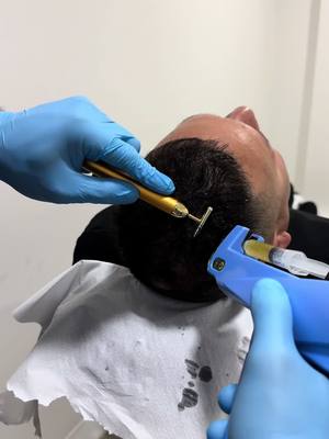 PRP CAPILAR #alopecia #medicinacapilar #caidadepelo #implantecapilar